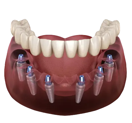 Імплантація зубів All-on-6