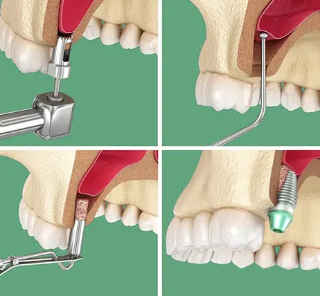 Синус-ліфтинг