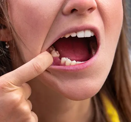 Ускладнення після видалення зуба