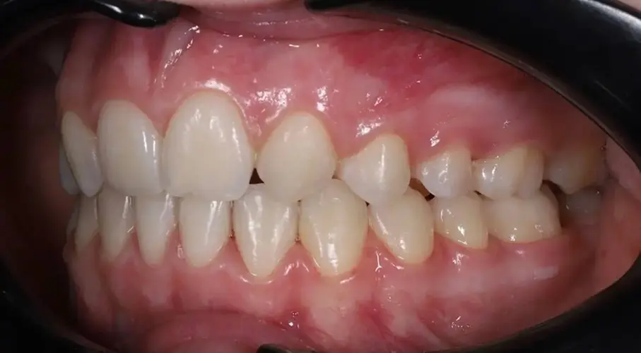 Брекети #2, фото 2