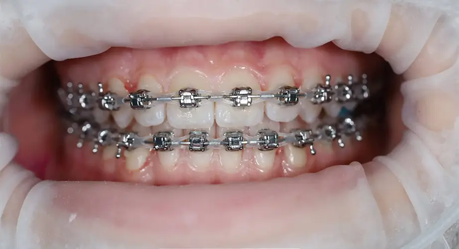 Брекети #3, фото 2