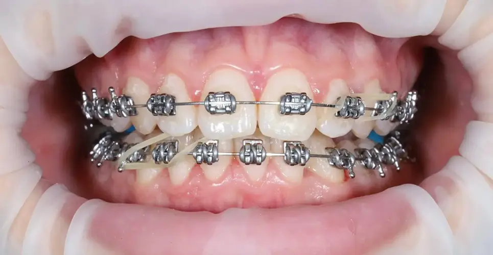 Брекети #5, фото 2