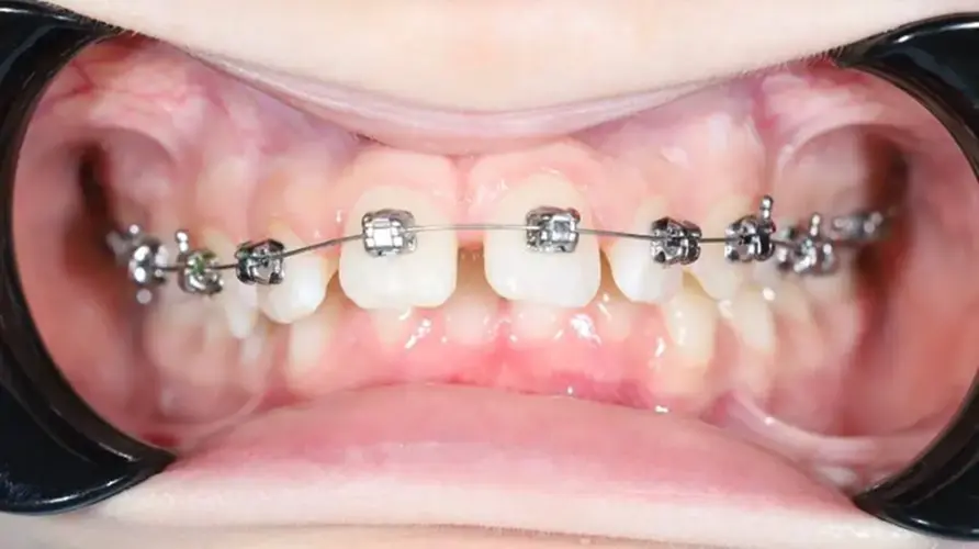 Брекети #1, фото 1