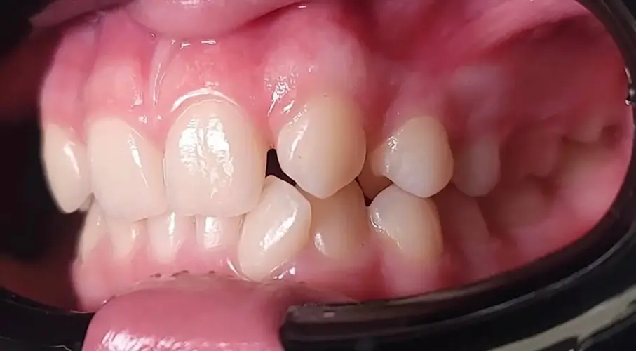 Брекети #2, фото 1